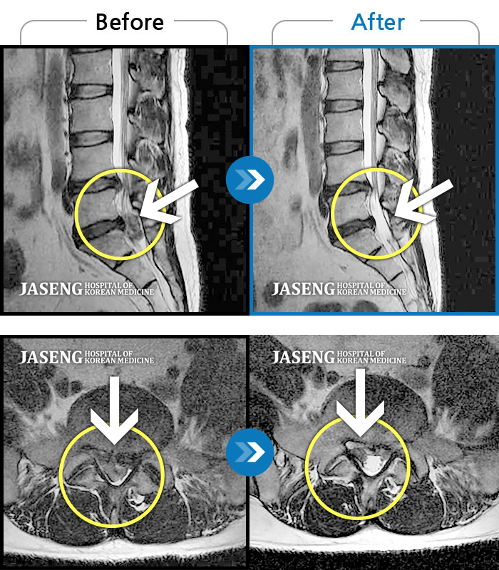 잠실자생한방병원 치료사례 MRI로 보는 치료결과-허리부터 우측골반, 우측 발바닥까지 저리고 힘이 빠졌다. 