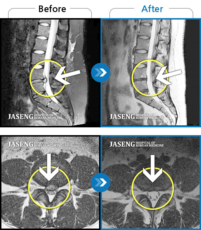 잠실자생한방병원 치료사례 MRI로 보는 치료결과-허리와 양 다리의 타는 통증으로 걷지 못한 상태로 내원