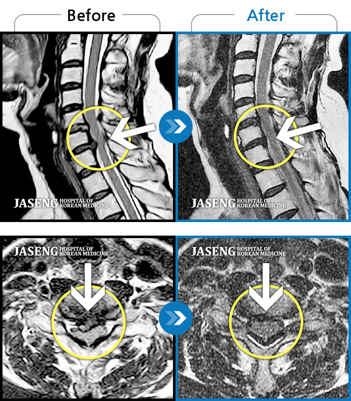잠실자생한방병원 치료사례 MRI로 보는 치료결과-견갑골 통증과 두통을 동반한 후경부 및 승모근의 극심한 통증