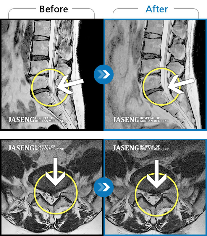 잠실자생한방병원 치료사례 MRI로 보는 치료결과-허리통증과 함께 좌측 엉치, 허벅지, 종아리 후면으로 저림이 심하여 걷기가 힘들어요.