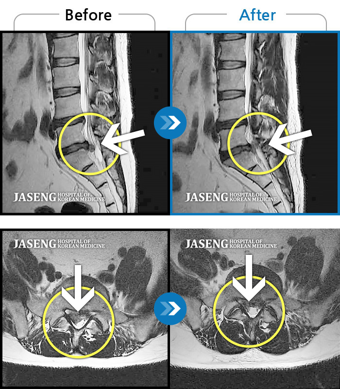 잠실자생한방병원 치료사례 MRI로 보는 치료결과-허리, 우측 엉치와 다리 후면 및 발끝까지 저림과 통증이 심하고 힘까지 빠진다.