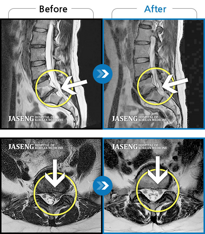 잠실자생한방병원 치료사례 MRI로 보는 치료결과-허리가 많이 아프고 왼쪽 다리가 저려 움직이기가 힘들다.