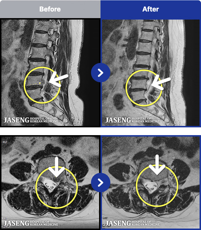 �ڻ��ѹ溴�� ġ���� MRI�� ���� ġ����-�㸮�� �ʹ� ������ �ٸ��� ������