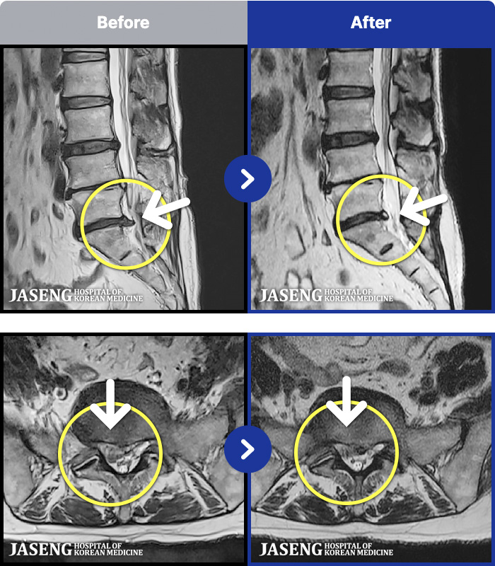 ��õ�ڻ��ѹ溴�� ġ���� MRI�� ���� ġ����-���� �߹ٴ��� ������ ������ �ִ� ���·� �����ϼ̽��ϴ�.