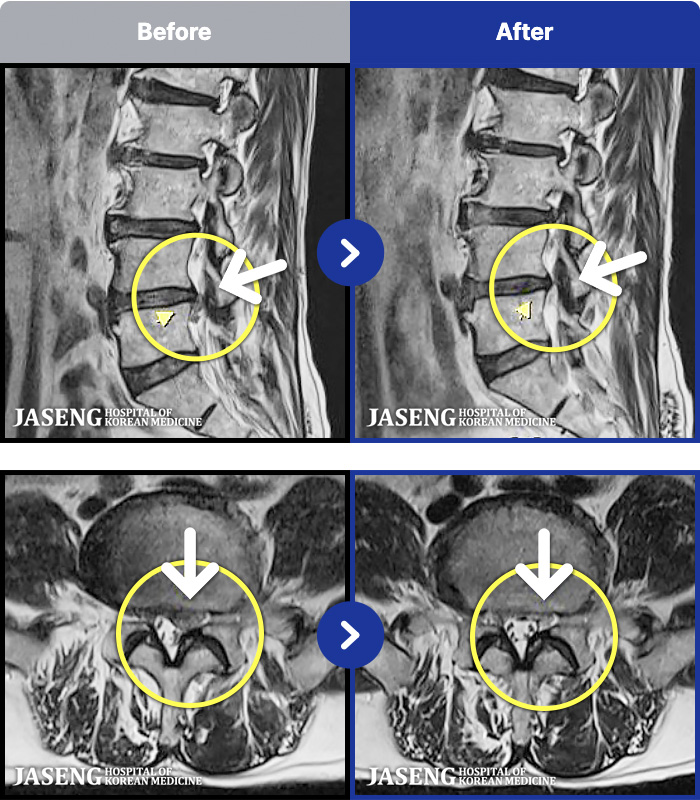 �ڻ��ѹ溴�� ġ���� MRI�� ���� ġ����-��ð� �ɰų�, �Ͼ�� ���� �� ������ ���� ������ ��ݺ��� �߳����� Į�� °�� ���� ������ ���� ������ �־����ϴ�. 