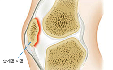 잠실자생한방병원 무릎질환 슬개골연골연화증-슬개골 연골이 위치해 있는 무릎 설명 이미지
