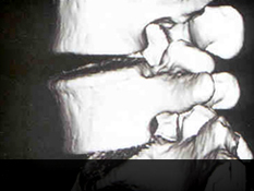 잠실자생한방병원 허리질환 퇴행성디스크-정상척추에 관련된 이미지 입니다.