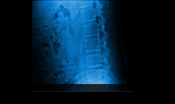 잠실자생한방병원 허리질환 척추후만증-척추후만증에 관련된 이미지 입니다.