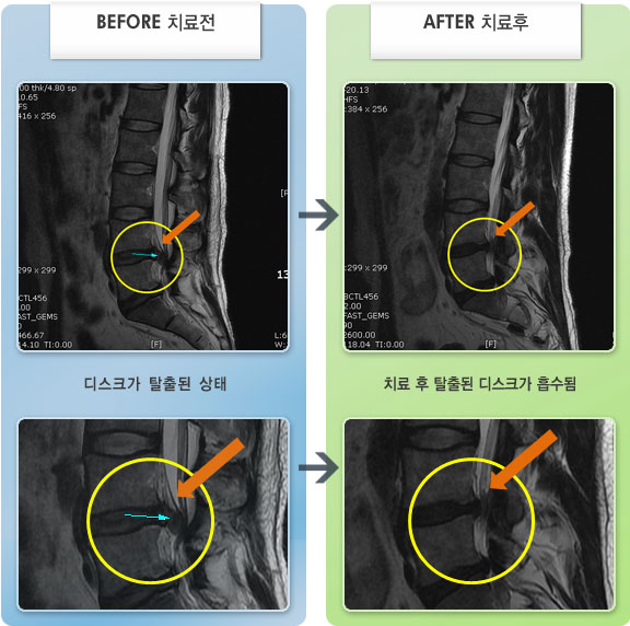 자생한방병원 치료사례 MRI로 보는 치료결과-갑자기 허리가 아파져 움직일수 없는 상태