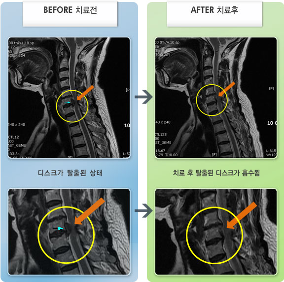 자생한방병원 치료사례 MRI로 보는 치료결과-뒷 목에서 시작하여 좌측 어깨, 팔 바깥쪽으로 저려 수면이 어려운 상태