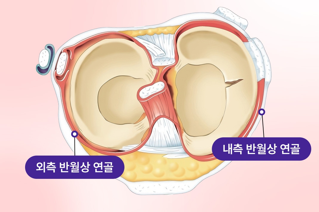 무릎 반월상 연골의 손상 부위를 표시한 일러스트